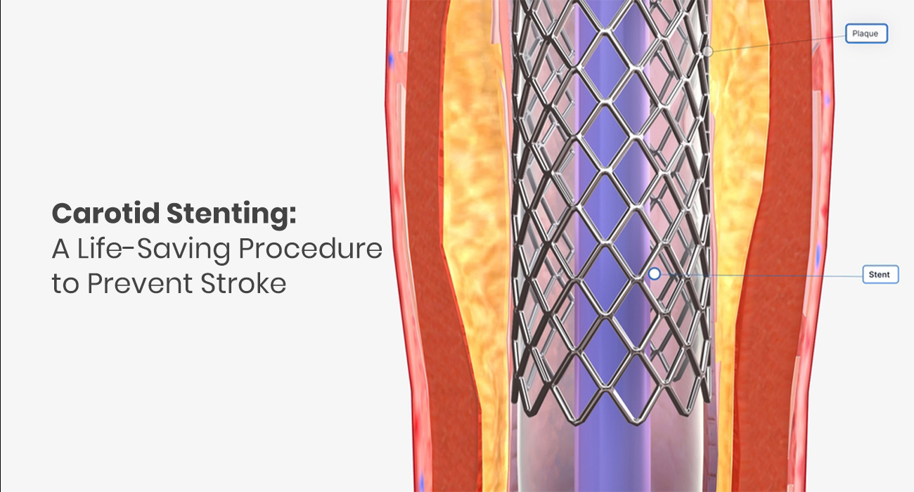 Carotid Artery Stenting vs Endarterectomy: Which Is Better for You
